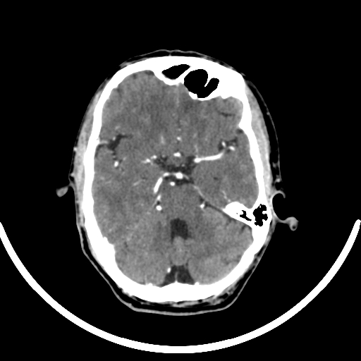 Chronic invasive fungal sinusitis with intraorbital and intracranial extension (Radiopaedia 56387-63046 B 136).jpg