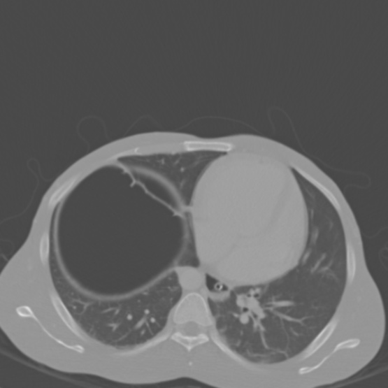 Chronic large bowel pseudo-obstruction (Radiopaedia 43181-46492 Axial bone window 21).jpg
