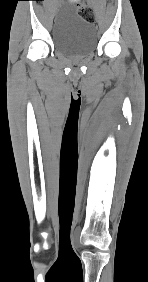 Chronic osteomyelitis (with sequestrum) (Radiopaedia 74813-85822 E 22).jpg