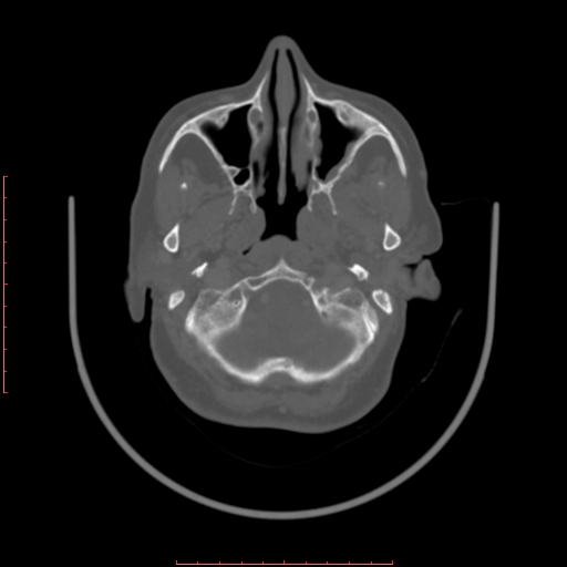 Chronic osteomyelitis - maxilla (Radiopaedia 23783-23927 Axial bone window 111).jpg
