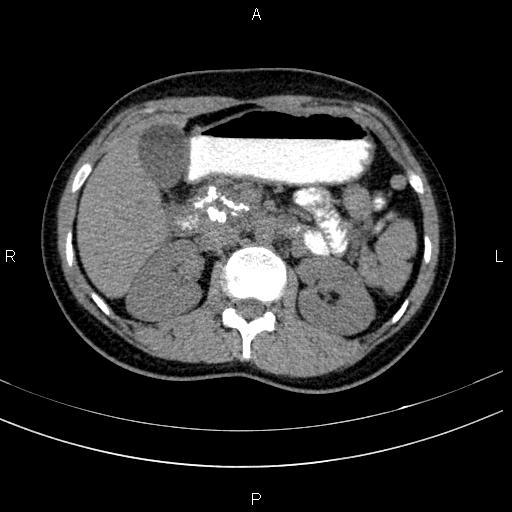 File:Chronic pancreatitis (Radiopaedia 64576-73450 Axial non-contrast 56).jpg