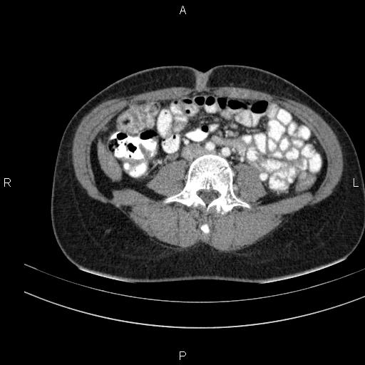 Chronic pancreatitis (Radiopaedia 64576-73450 B 97).jpg
