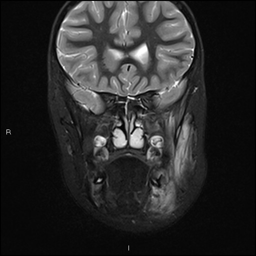 File:Chronic reactive multifocal osteomyelitis (CRMO) - mandible (Radiopaedia 56405-63069 Coronal STIR 14).jpg