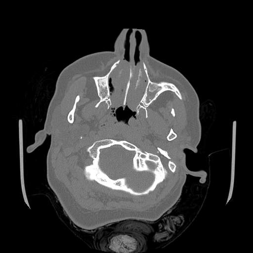 Chronic sinusitis with intra-sinus calcification (Radiopaedia 63919-72668 Axial bone window 68).jpg