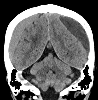Chronic subdural hematomas (Radiopaedia 66577-75885 Coronal non-contrast 44).jpg