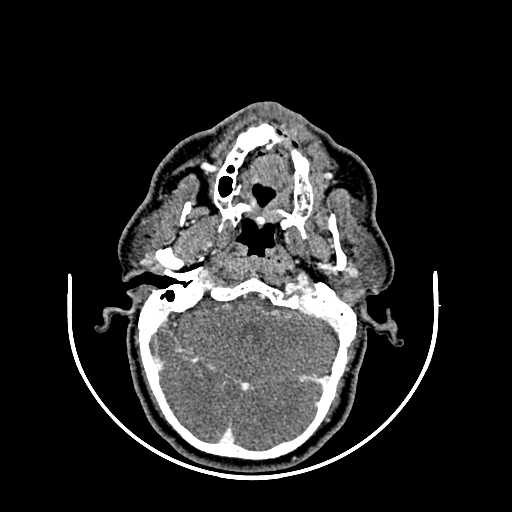 File:Chronic submandibular abscess (Radiopaedia 21738-21718 A 3).jpg