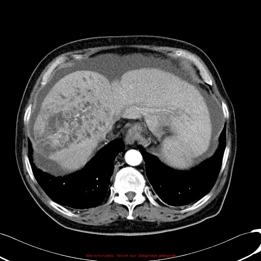 File:Cirrhosis and hepatocellular carcinoma in the setting of hemochromatosis (Radiopaedia 75394-86595 A 21).jpg