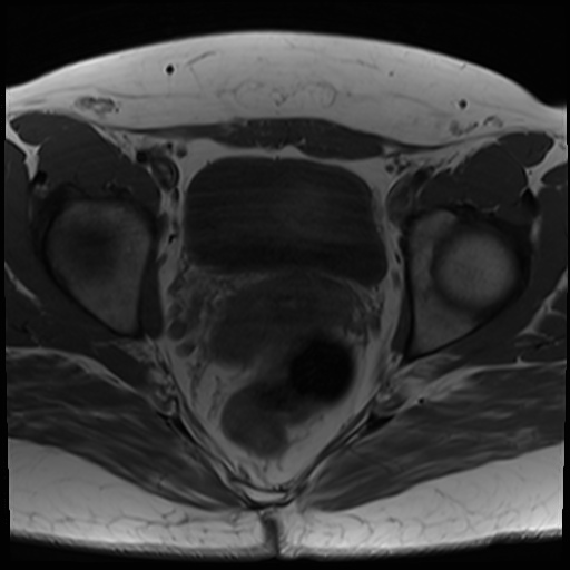 File:Class II Mullerian duct anomaly- unicornuate uterus with rudimentary horn and non-communicating cavity (Radiopaedia 39441-41755 Axial T1 19).jpg