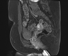 Class II Mullerian duct anomaly- unicornuate uterus with rudimentary horn and non-communicating cavity (Radiopaedia 39441-41755 G 65).jpg