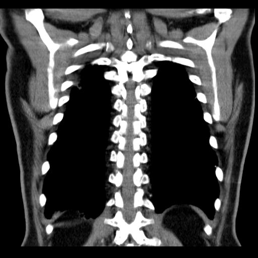 File:Classic complicated silicosis (Radiopaedia 49720-54961 Coronal liver window 52).jpg