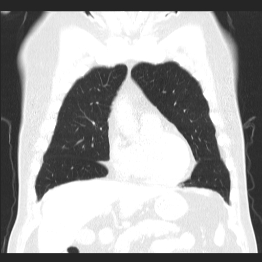 File:Classic complicated silicosis (Radiopaedia 49720-54961 Coronal lung window 17).jpg