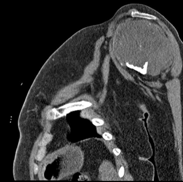 File:Clear cell chondrosarcoma - humerus (Radiopaedia 63104-71612 D 28).jpg
