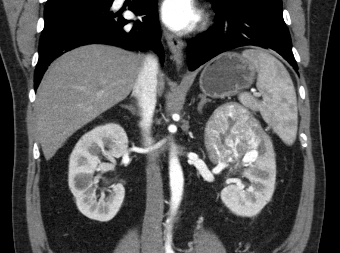 File:Clear cell renal cell carcinoma (Radiopaedia 61449-69393 C 20).jpg