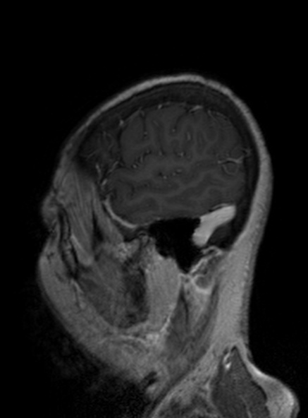 Clival meningioma (Radiopaedia 53278-59248 Sagittal T1 C+ 156).jpg
