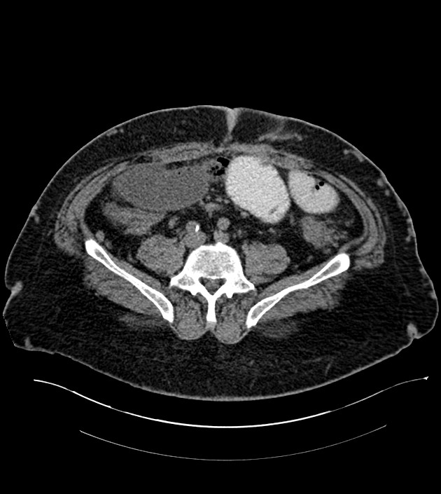 Closed-loop small bowel obstruction-internal hernia (Radiopaedia 78439-91096 Axial non-contrast 106).jpg
