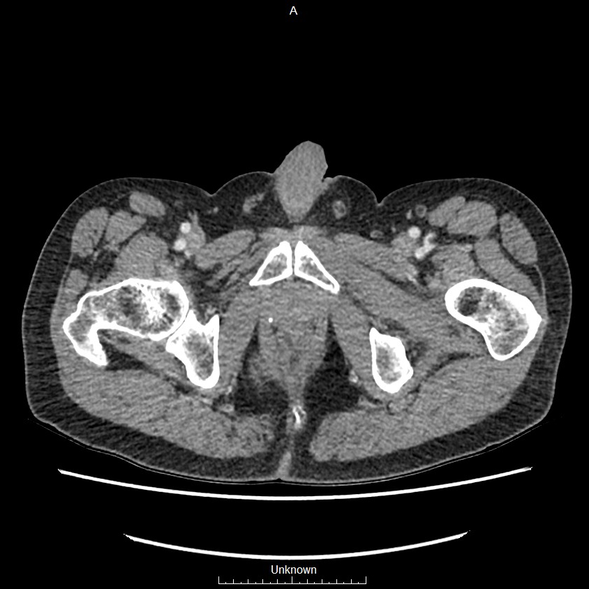 Closed loop bowel obstruction and ischemia (Radiopaedia 86959-103180 A 92).jpg