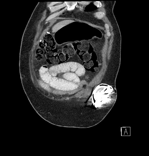 Closed loop obstruction - internal hernia into nephrectomy bed (Radiopaedia 59867-67320 B 10).jpg