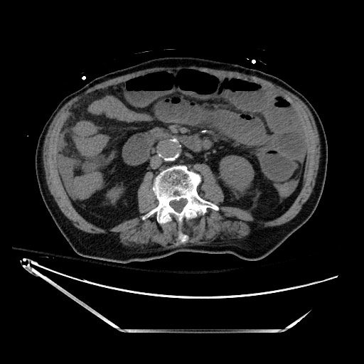 File:Closed loop obstruction due to adhesive band, resulting in small bowel ischemia and resection (Radiopaedia 83835-99023 Axial 55).jpg
