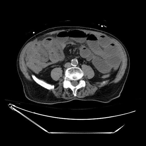 Closed loop obstruction due to adhesive band, resulting in small bowel ischemia and resection (Radiopaedia 83835-99023 Axial non-contrast 92).jpg