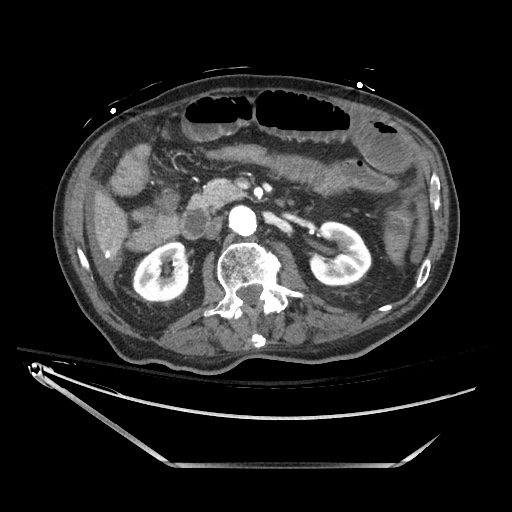 Closed loop obstruction due to adhesive band, resulting in small bowel ischemia and resection (Radiopaedia 83835-99023 B 63).jpg