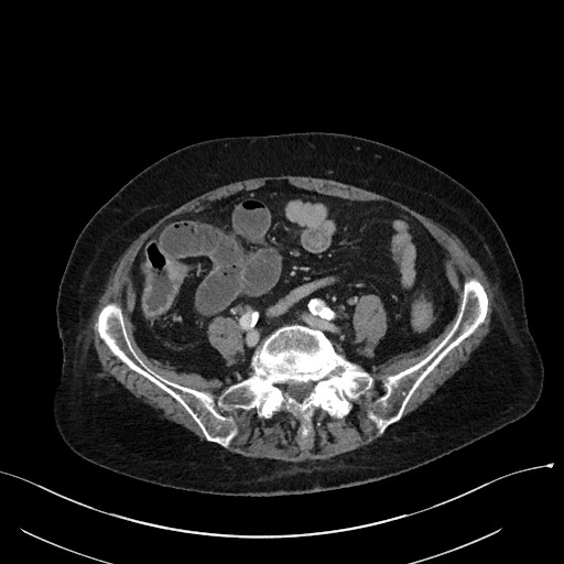 Closed loop small bowel obstruction - adhesions (Radiopaedia 59269-66611 A 88).jpg