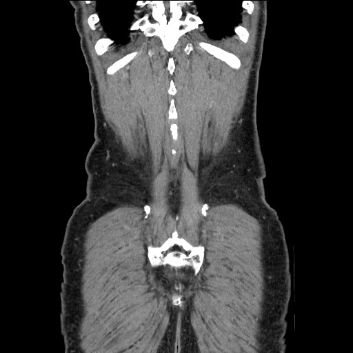 Closed loop small bowel obstruction - omental adhesion causing "internal hernia" (Radiopaedia 85129-100682 B 115).jpg