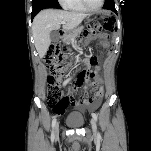 Closed loop small bowel obstruction - omental adhesion causing "internal hernia" (Radiopaedia 85129-100682 B 48).jpg
