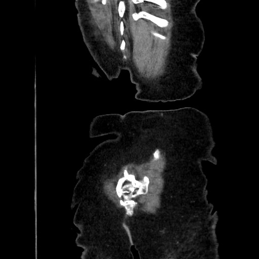 File:Closed loop small bowel obstruction due to adhesive band, with intramural hemorrhage and ischemia (Radiopaedia 83831-99017 C 116).jpg