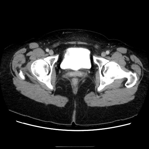 Closed loop small bowel obstruction due to adhesive bands - early and late images (Radiopaedia 83830-99015 A 162).jpg
