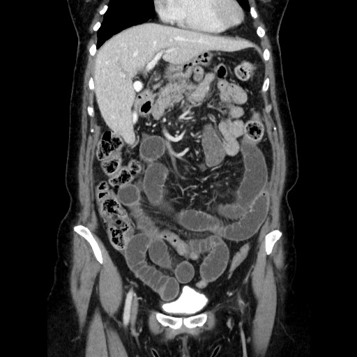 File:Closed loop small bowel obstruction due to adhesive bands - early and late images (Radiopaedia 83830-99015 B 45).jpg