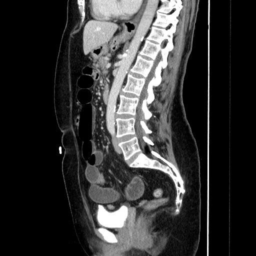 Closed loop small bowel obstruction due to adhesive bands - early and late images (Radiopaedia 83830-99015 C 97).jpg