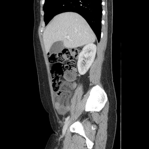 Closed loop small bowel obstruction due to trans-omental herniation (Radiopaedia 35593-37109 C 21).jpg