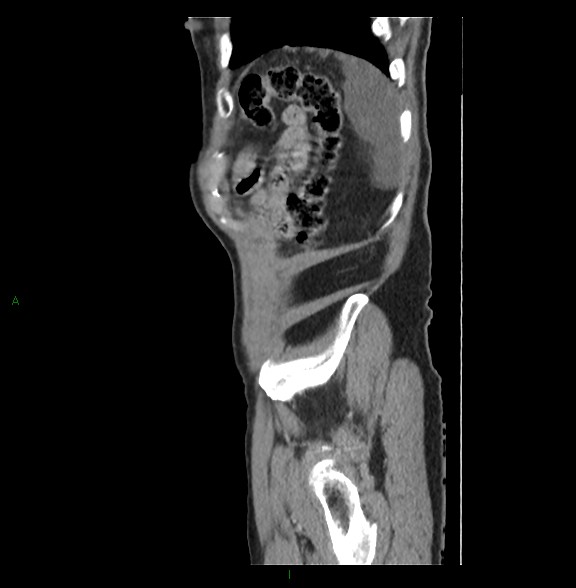 Closed loop small bowel obstruction with ischemia (Radiopaedia 84180-99456 C 81).jpg
