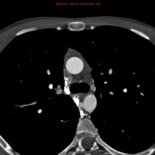 File:Coarctation of the aorta (Radiopaedia 12461-12697 A 134).jpg