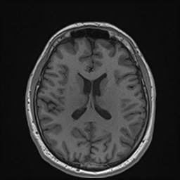 File:Cochlear incomplete partition type III associated with hypothalamic hamartoma (Radiopaedia 88756-105498 Axial T1 119).jpg