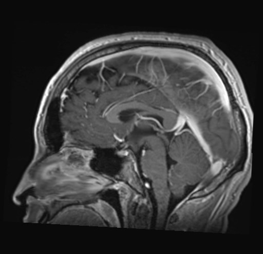 Cochlear incomplete partition type III associated with hypothalamic hamartoma (Radiopaedia 88756-105498 Sagittal T1 C+ 28).jpg