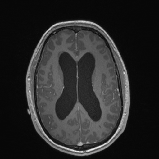 File:Colloid cyst (Radiopaedia 44510-48181 Axial T1 C+ 111).png
