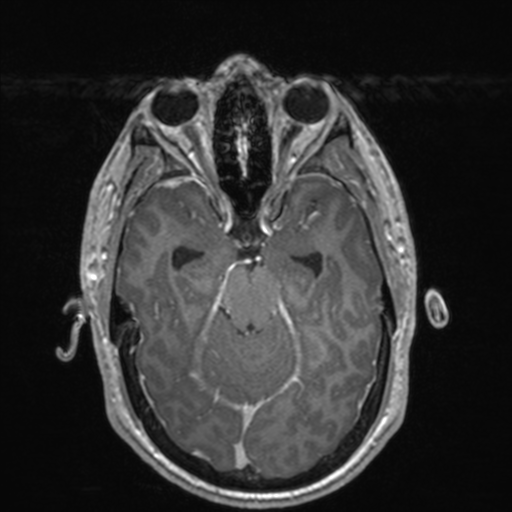 File:Colloid cyst (Radiopaedia 44510-48181 Axial T1 C+ 70).png