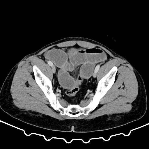 Colocolic intussusception due to large lipoma (Radiopaedia 68773-78482 A 163).jpg
