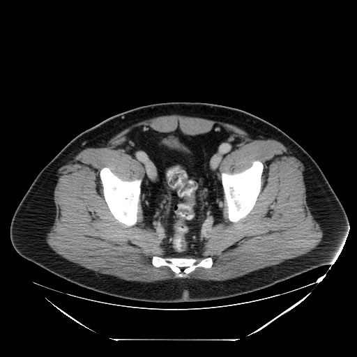 Colocolic intussusception due to lipoma (Radiopaedia 73712-84508 A 103).jpg