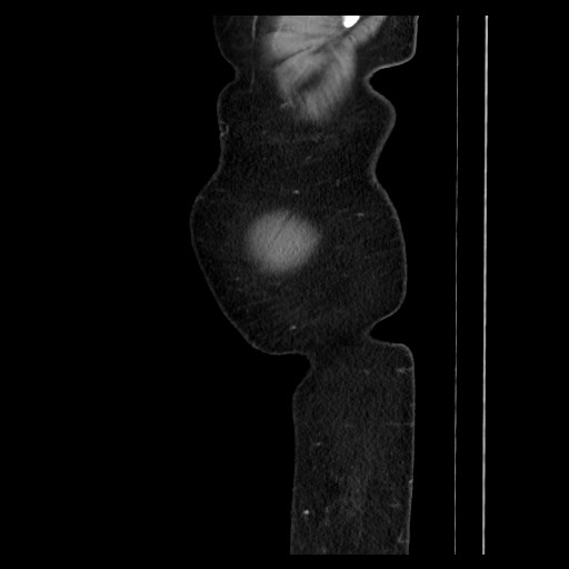 Colocolic intussusception due to tubular adenoma (Radiopaedia 73744-84551 C 18).jpg