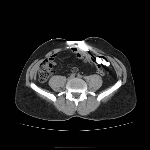 File:Colocutaneous fistula in Crohn's disease (Radiopaedia 29586-30093 D 17).jpg
