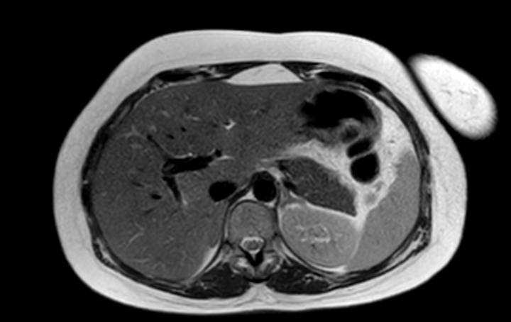 Colon adenocarcinoma with Krukenberg tumors, advanced pregnancy (Radiopaedia 67279-76645 Axial T2 65).jpg