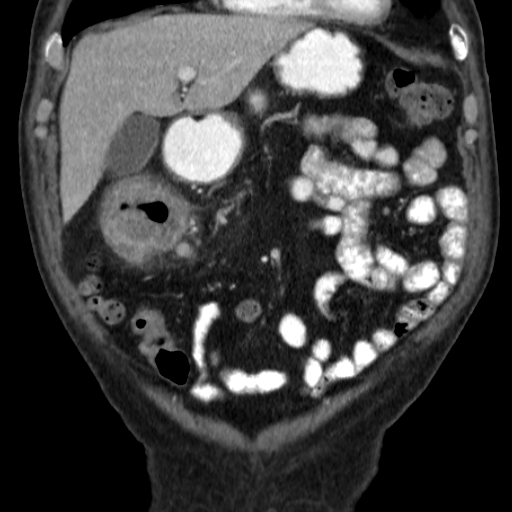 File:Colon cancer with duodenal invasion (Radiopaedia 16278-15958 B 17).jpg