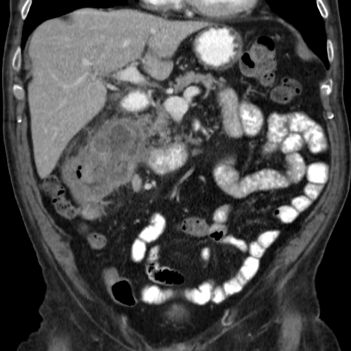 File:Colon cancer with duodenal invasion (Radiopaedia 16278-15958 B 24).jpg
