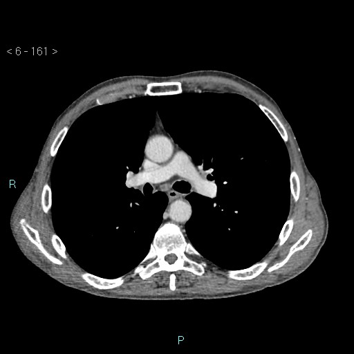 Colonic cancer (ultrasound and TC imaging) (Radiopaedia 50346-55713 B 161).jpg