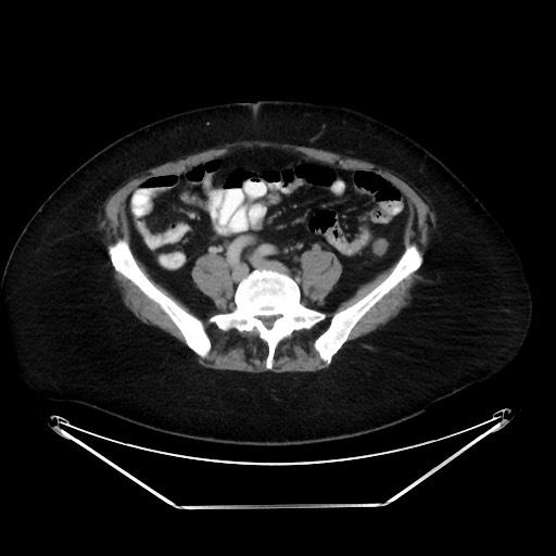 File:Colonic intussusception due to adenocarcinoma (Radiopaedia 86828-102987 A 101).jpg