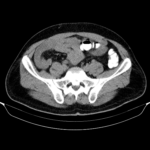 Colonic lipoma with colo-colic intussusception (Radiopaedia 58944-66200 Axial C+ rectal 51).jpg