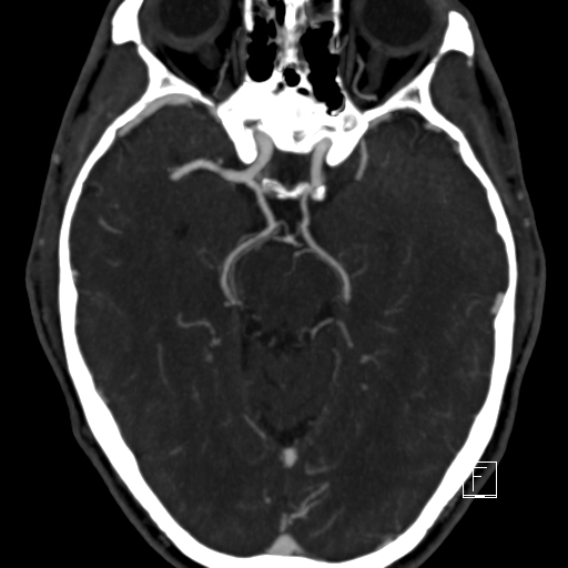 File:Fetal posterior communicating artery (Radiopaedia 36133).jpg