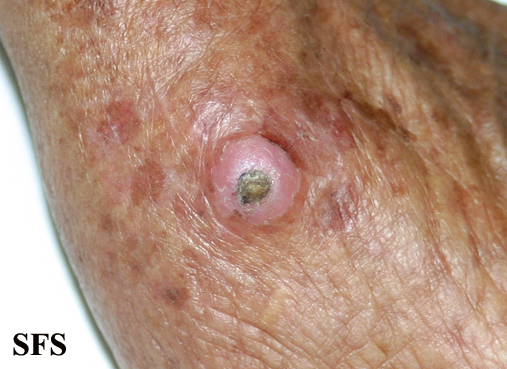 File:Keratoacanthoma (Dermatology Atlas 57).jpg